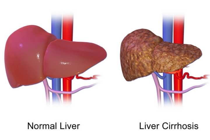 Liver Damage