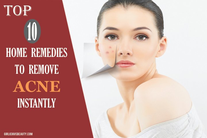 How To Remove Acne Instantly – Top 10  Home Remedies