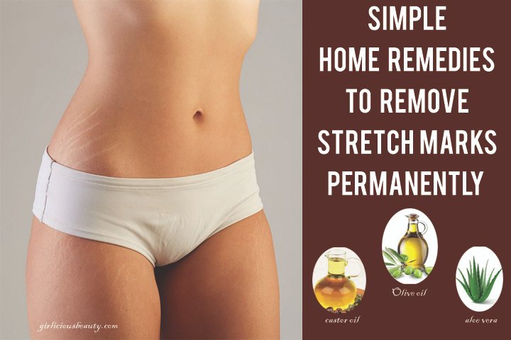 Simple Home Remedies To Remove Stretch Marks Permanently