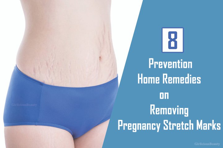 Prevention Home Remedies On Removing Pregnancy Stretch Marks