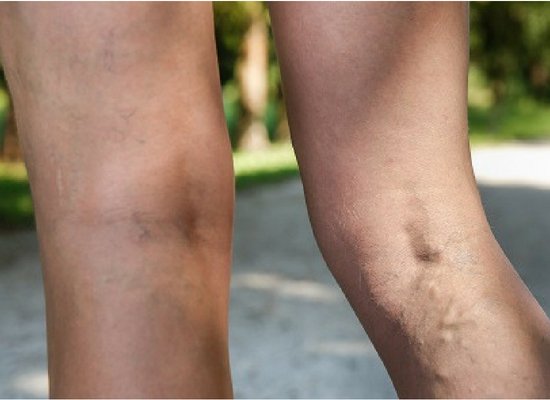 Treats varicose veins