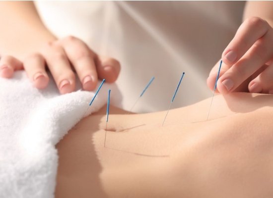 Acupuncture