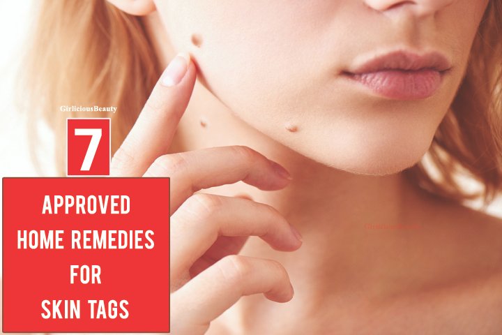 SKIN TAGS