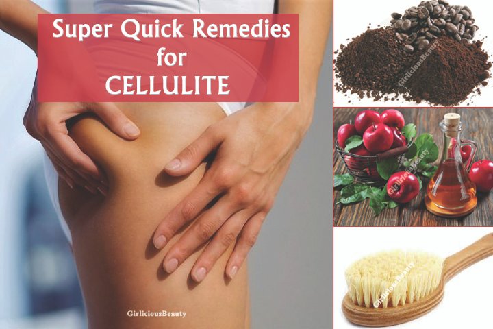 CELLULITE