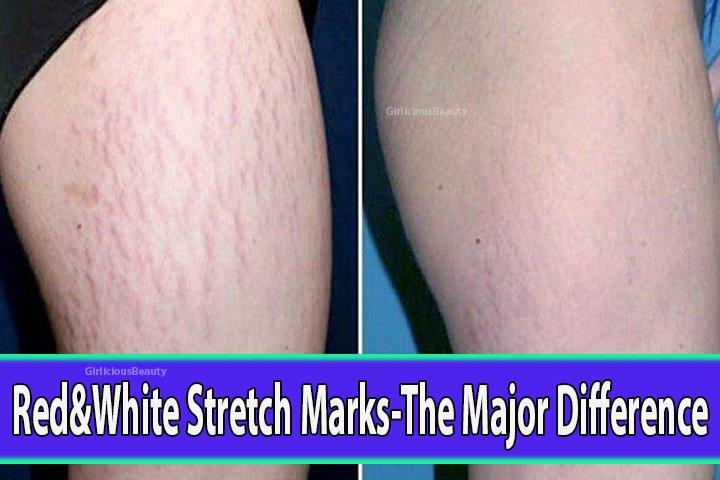 Major Differences Between red and white stretch marks