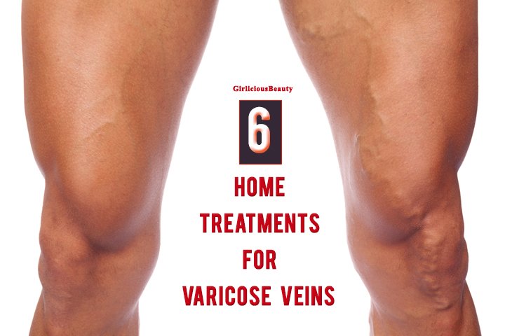 VARICOSE VEINS