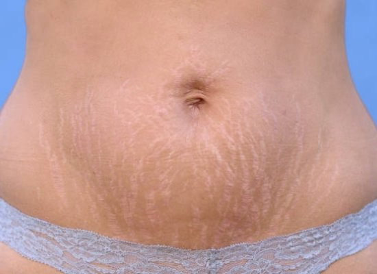 White stretch marks