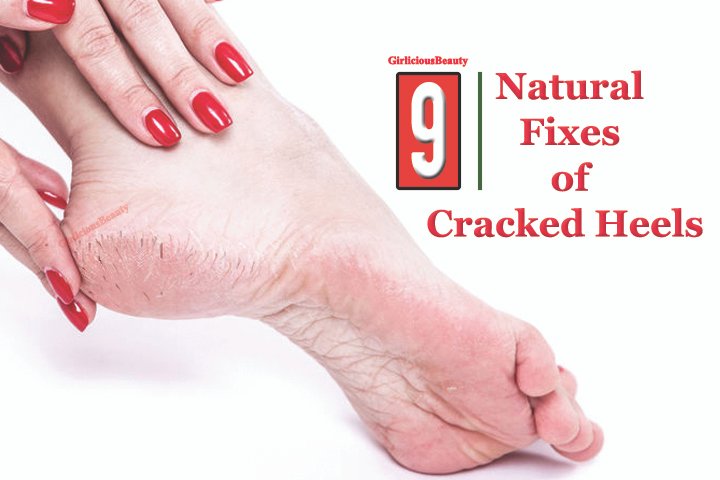 9 Natural Fixes Of Cracked Heels – Get Smooth Feet