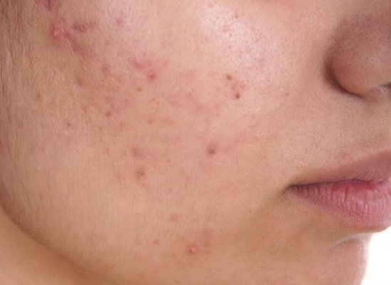 skin disorders