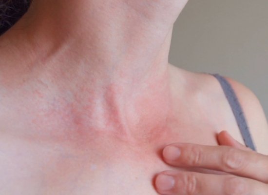 Irritation and sun burn
