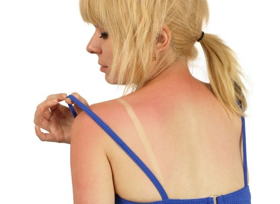 Sunburn