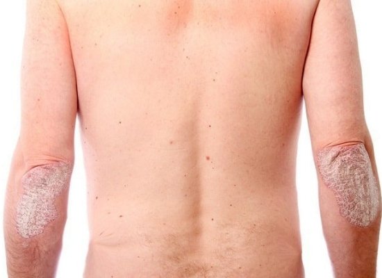 Treats psoriasis