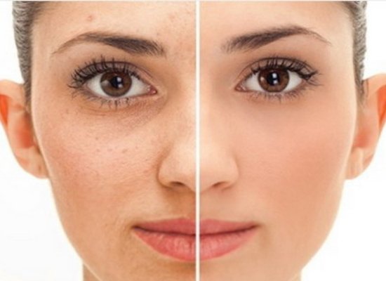 dark circle and wrinkles
