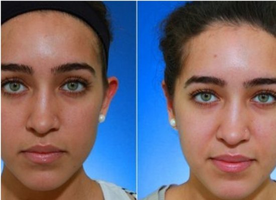 Chemical peels