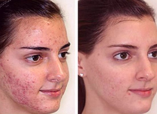Dermabrasion