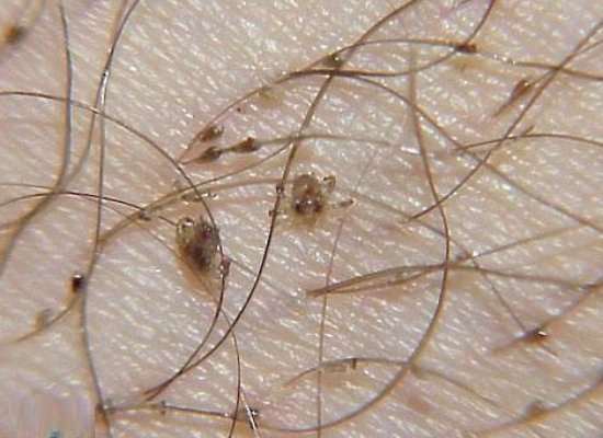 Pubic lice
