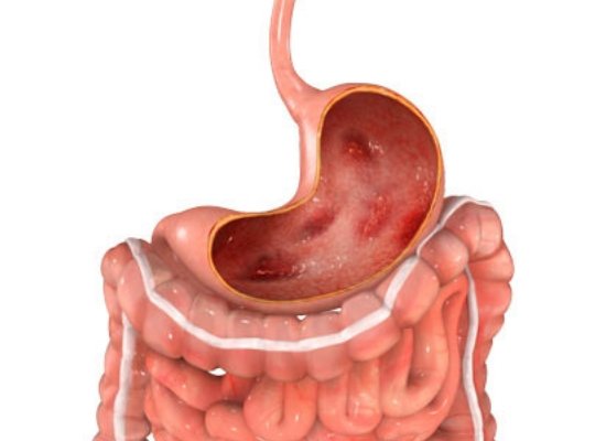 Stomach Ulcers