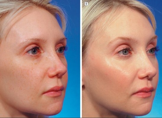 Fractional laser treatment