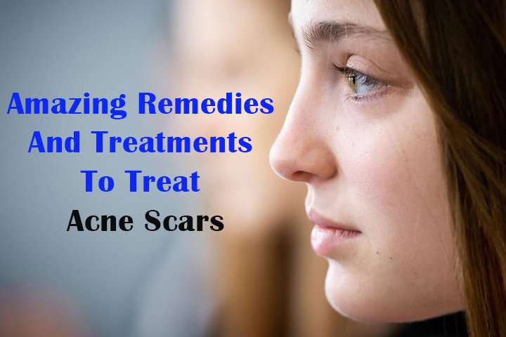 Amazing Remedies And Treatments To Treat Acne Scars
