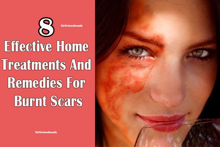 8 Effective Home Treatments And Remedies For Burn Scars