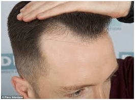 Things to know about Hair Transplant in Gurgaon