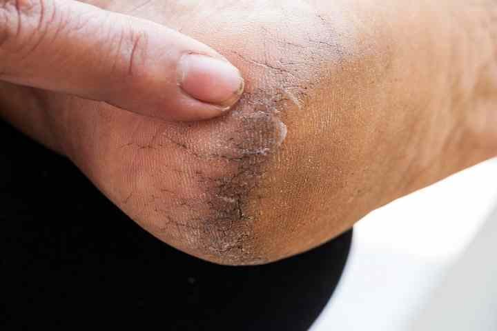 Home-Remedies-For-Cracked-heel
