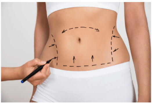Liposuction