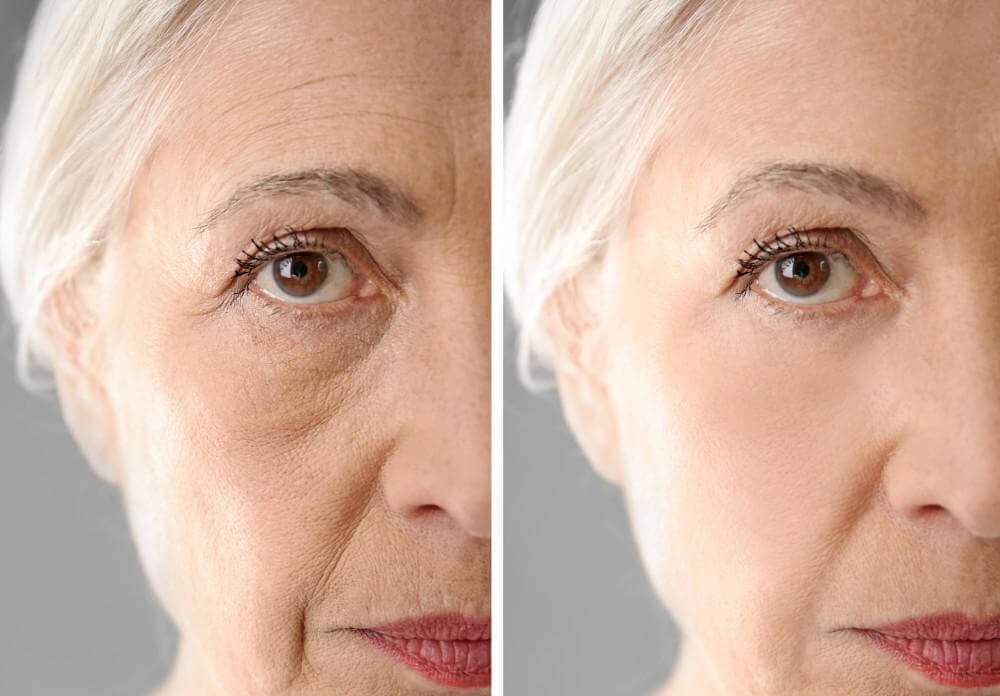 Anti Aging