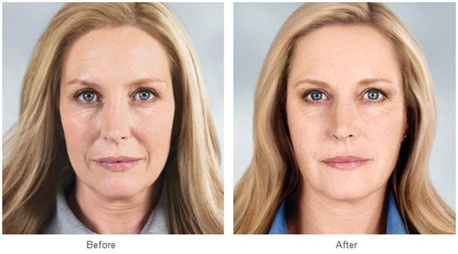 Liquid Facelift