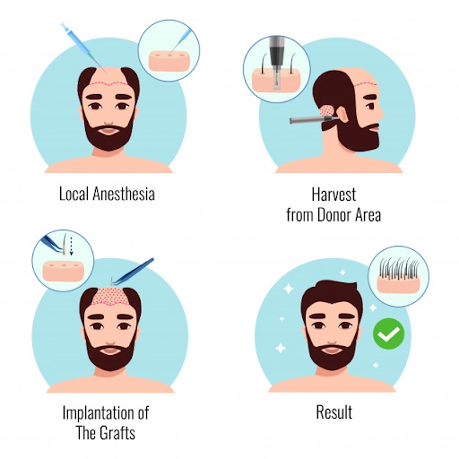 hair transplants