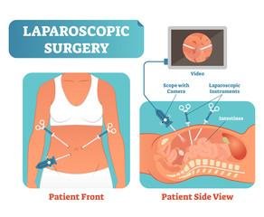 Laparoscopy1