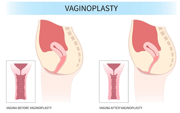 vaginoplasty