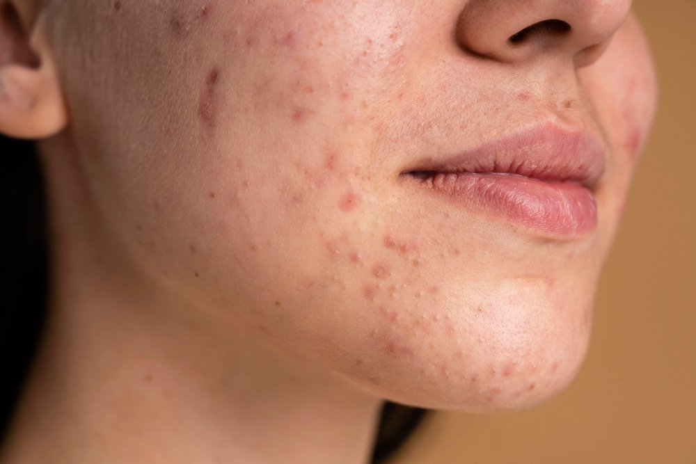 Skin Breakouts