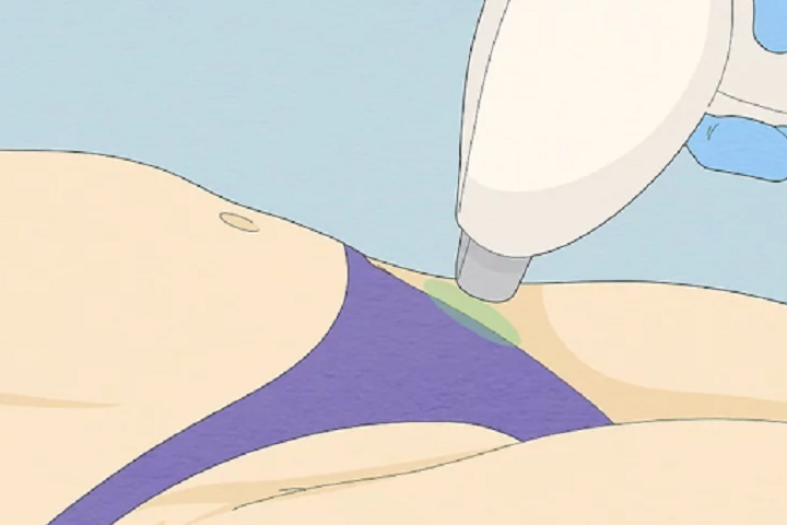 Best Ways to Remove Pubic Hair: Safely and At Home