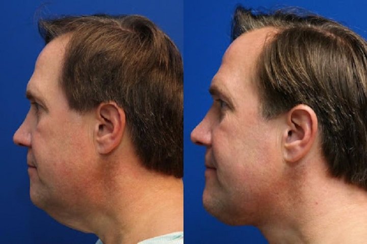 Tips for Minimizing the Appearance of Deep Plane Facelift Scars